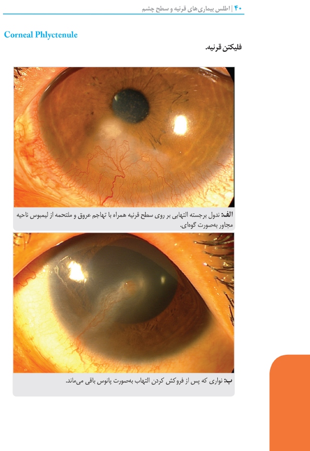 اطلس بیماری های قرنیه و سطح چشم